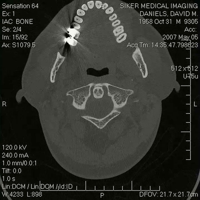 Freaked - David Daniels MRI